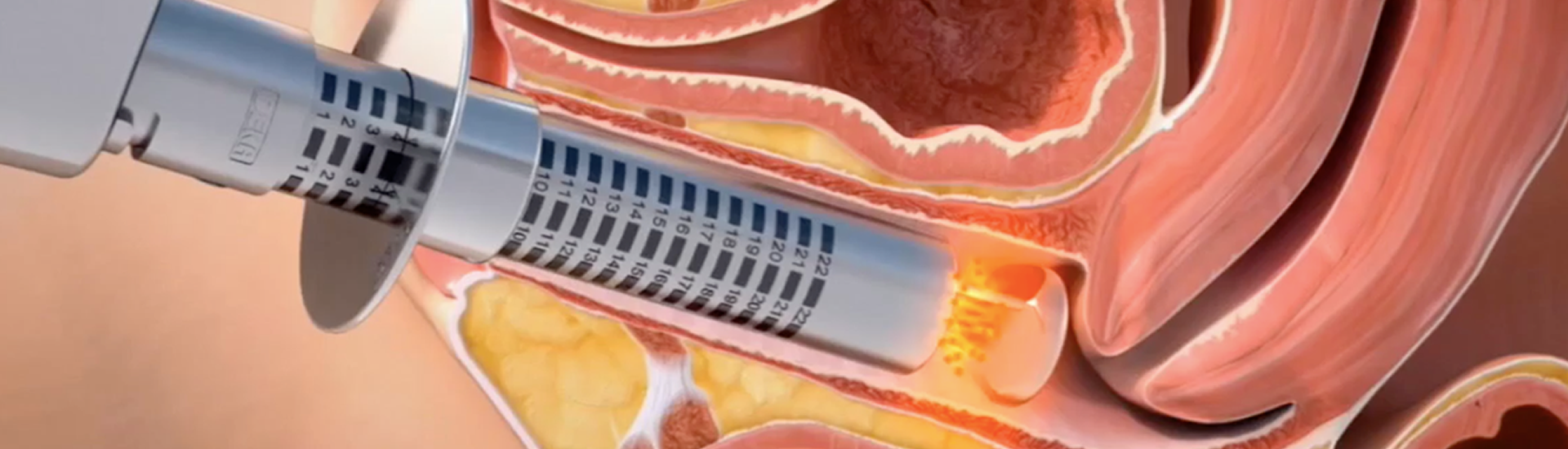 GINECOESTÉTICA Y CIRUGÍA ÍNTIMA